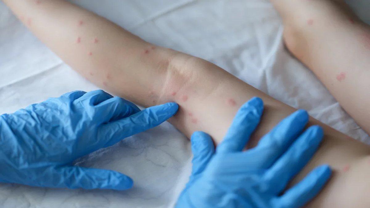 Ministro da Saúde diz que Brasil vai receber antiviral para enfrentamento da varíola dos macacos.